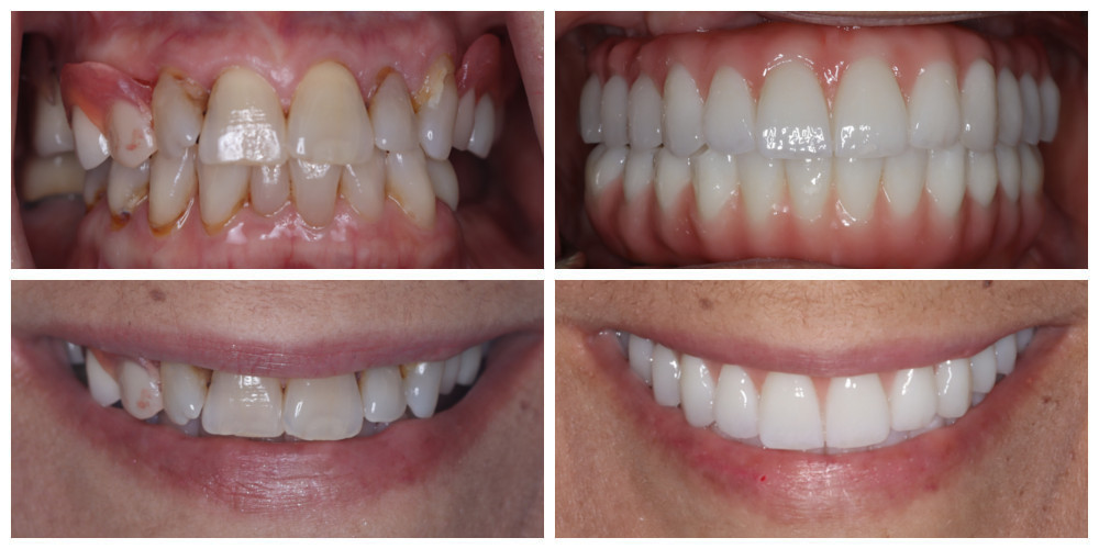 Double Arch - Hybrid Zirconia