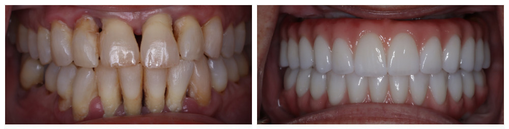 Double Arch - Hybrid Zirconia