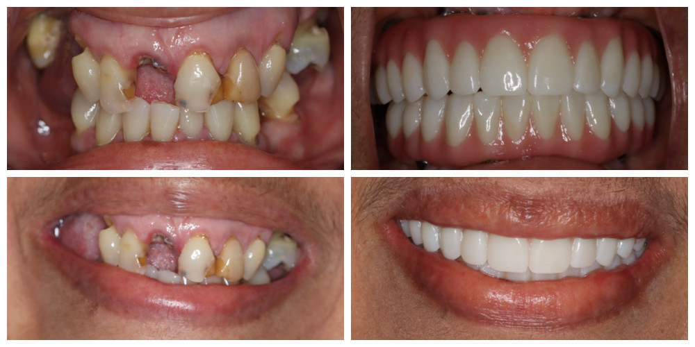 Double Arch - Hybrid Zirconia